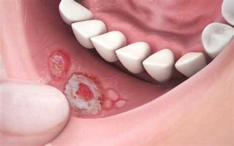 Las Aftas O Lceras Bucales Causas S Ntomas Y Prevenci N Cl Nica
