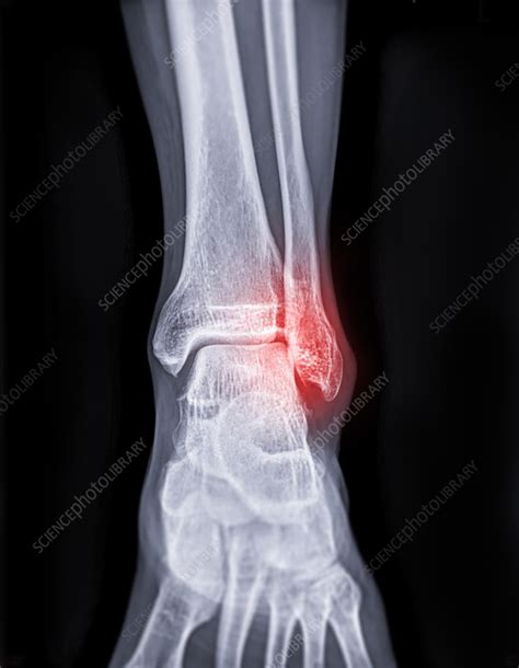 Broken ankle, X-ray - Stock Image - F036/9893 - Science Photo Library