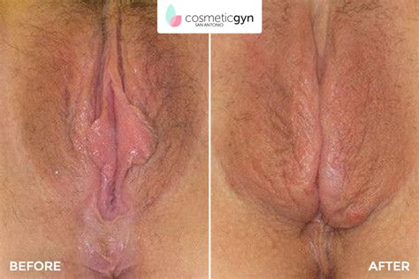 Labiaplasty Gone Wrong Photos