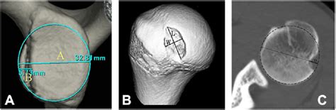 quantification method  glenoid defect size  hill sachs lesion