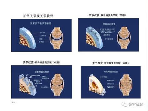 膝关节骨性关节炎的认识和手术治疗 好医术早读文章 好医术 赋能医生守护生命