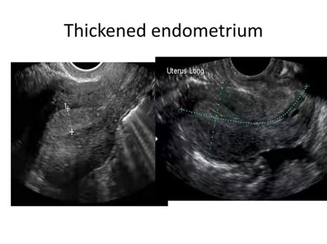 First trimester ultrasound