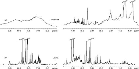 Examples Of Standard Nmr Spectra Of Serum And Urine Showing Repre