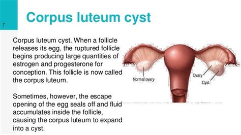 Ovarian Cyst Causes | Ovarian Cyst Treatment |Ovarian Cyst Pain