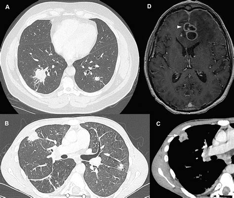 Invasive Nocardiosis: Disease Presentation, Diagnosis and Treatment &n ...