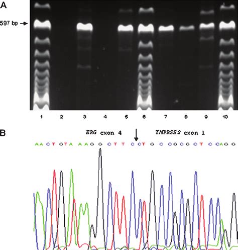 Detection And Analysis Of Type A Tmprss Erg Fusion Transcript In