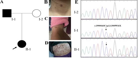 Whole Exome Sequencing Identified A Novel Frameshift Mutation Of