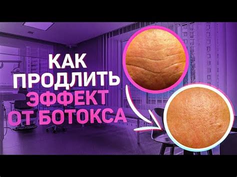 Как сохранить эффект от ботокса YouTube