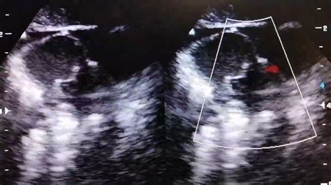 Atrial Septal Aneurysm Asa With Patent Foramen Ovale Pfo Youtube