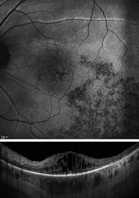 Diagnosis of Cystoid Macular Edema: Imaging | Ento Key