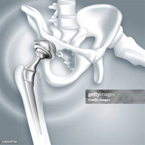 hip joint replacement stock  high res pictures  images