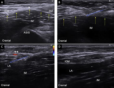 Fascia Iliaca Compartment Block Bja Education