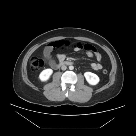 File Bowel Ischemia Mesenteric Arterial Vascular Occlusion