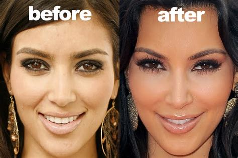 Kim Kardashian Plastic Surgery Before And After - Plastic Celebrity Surgery