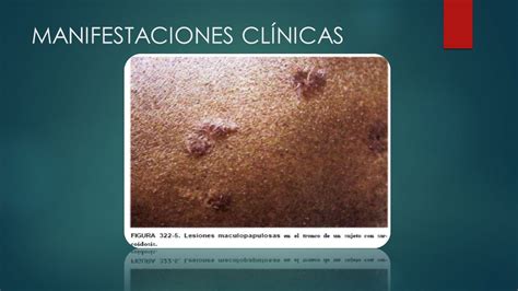 Inflamaci N Granulomatosa Seminario De Patologia Inflamaci N