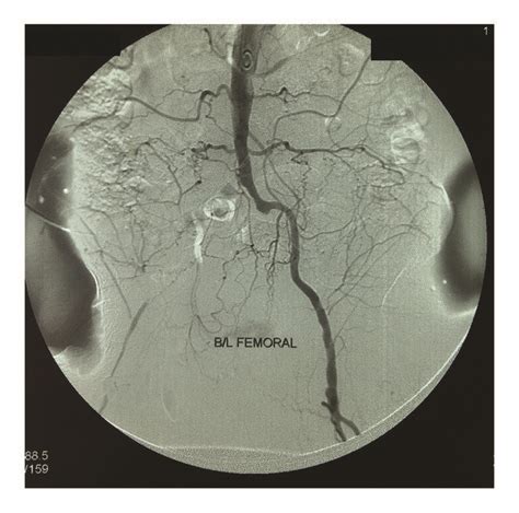 Digital Subtraction Angiography Showing Severe Long Segment Stenosis Of