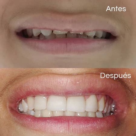 Antes Y Despu S Dise O De Sonrisa Carillas Dentales De Diana Patricia