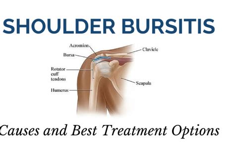 Treating Shoulder Bursitis - Niagara Shoulder Pain Clinic