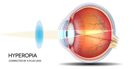 Hyperopia - Symptoms, Causes and Treatment | FYEyes