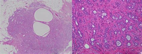 A A Relatively Well Circumscribed Tumor Composed Of Myoepithelial