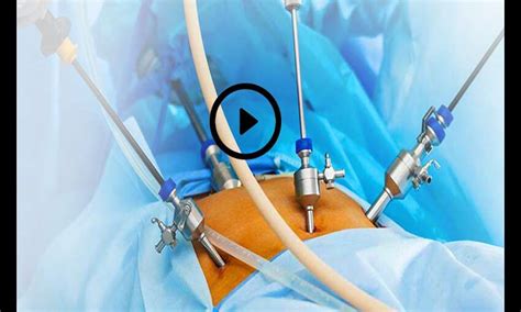 Laparoscopy Superior To Laparotomy For Managing Ruptured Tubal Ectopic