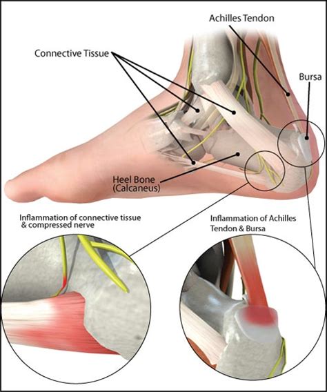 Plantar Fasciitis — Southeast Michigan Center For Orthopedics