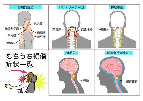 むち打ち症（頚椎捻挫） 症状について 【漫画で解説】いすみ市の交通事故後のケアなら鍼灸接骨院てあて