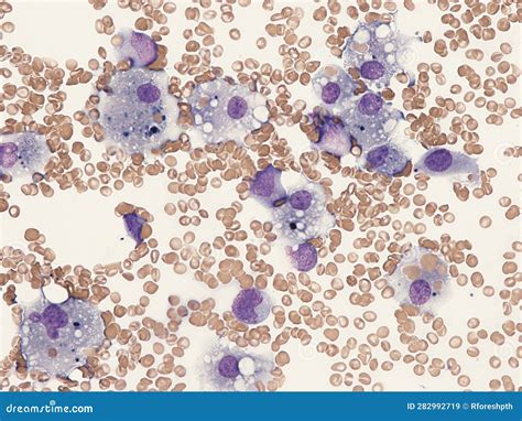 Macrophage Proliferation In A Case Of Hemophagocytic Syndrome Stock