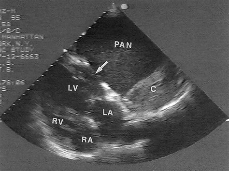 Giant Left Ventricular Pseudoaneurysm Circulation