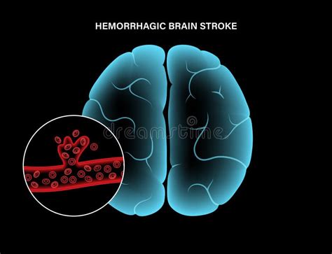 Brain Hemorrhage Anatomy Stock Illustrations 391 Brain Hemorrhage