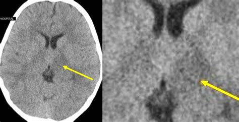 Axial CT image of brain at the level of basal ganglia demonstrate mild ...