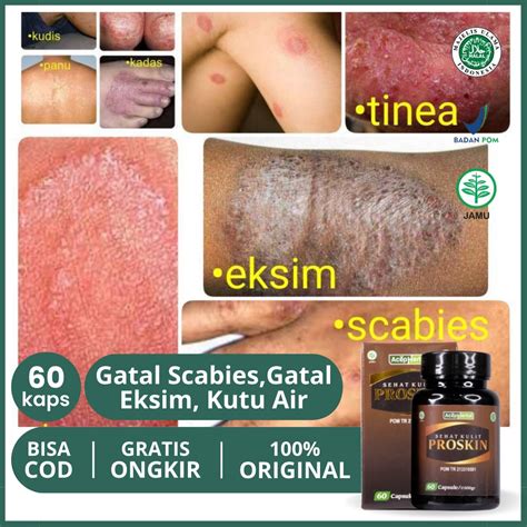 Jual Obat Infeksi Kulit Bernanah Gatal Timbul Bercak Bintik Merah