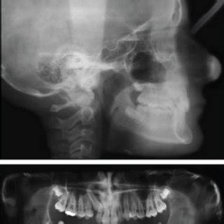 Pretreatment Radiographs A Lateral Cephalogram And Tracing B