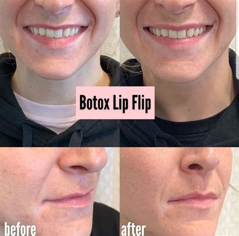 Lip Flip Before And After Photos