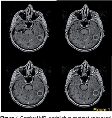 Figure From Peritumoral And Intratumoral Hemorrhage After