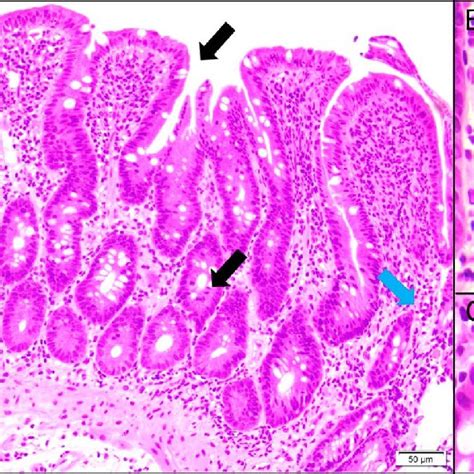 A Duodenal Biopsy At The Repeated Endoscopy Hematoxylin And Eosin