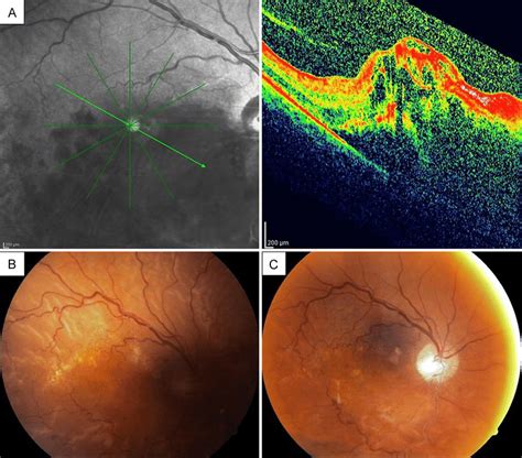 Case Right Eye A Optical Coherence Tomograph Oct Showing Immense