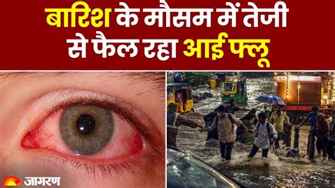 Eye Flu मानसून में तेजी से फैल रहा आई फ्लू जानें इसके लक्षण और बचाव