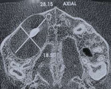 A Computed Tomography Scan Axial Of The Face Showing A Hypodense