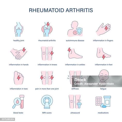 류마티스 관절염 증상 진단 및 치료 벡터 아이콘 의료 아이콘 무릎에 대한 스톡 벡터 아트 및 기타 이미지 무릎 부은