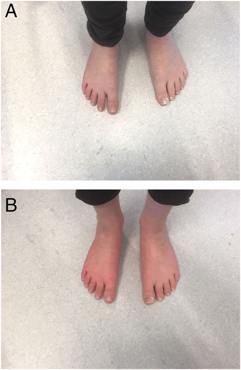 PSSD, Withdrawal & Small Fiber Neuropathy? - RxISK