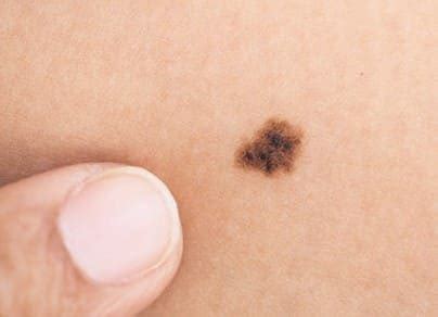 Melanoma Benigno Melanoma