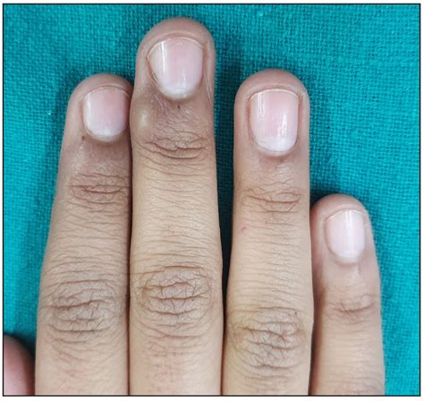 Clinical Characteristics And Management Outcomes In Isolated Nail