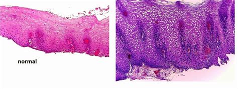 Acanthosis Histology