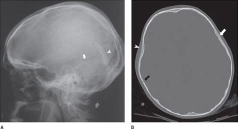 Simple Skull Fracture