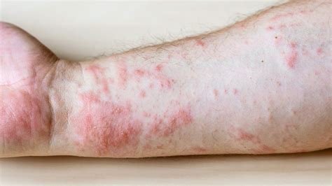 Rash And Skin That Feels Hot To The Touch Causes And Photos