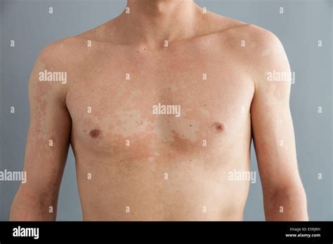 Pityriasis Versicolor Hi Res Stock Photography And Images Alamy