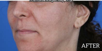 Patient #651 Melasma Before and After Photos Beverly Hills, CA ...