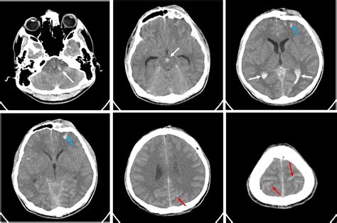 Frontal bone fracture and frontal sinus injury – Radiology Cases