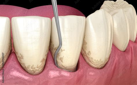 Closed Curettage Scaling And Root Planing Conventional Periodontal